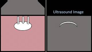 Clean posterior acoustic shadowing screenshot 3