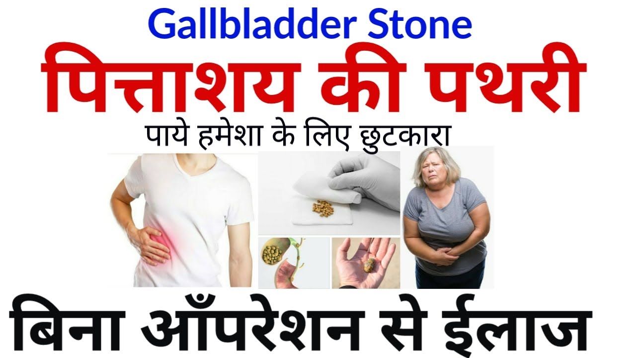 Gallbladder Stone पित्ताशय की पथरी का बिना आँपरेशन से ईलाज। पाये हमेशा