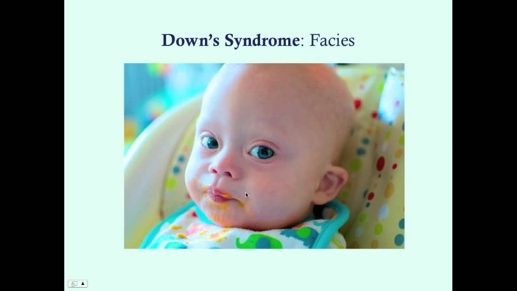 Downs Syndrome CRASH! Medical Review Series YouTube