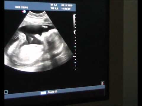 Узи 6 месяцев. УЗИ 9 месяцев беременности мальчик. Снимок УЗИ на 6 месяце мальчик.