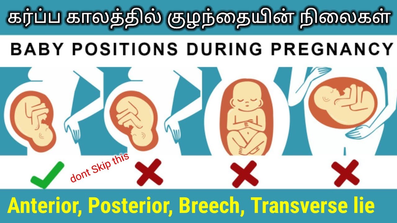 transverse lie presentation meaning in tamil