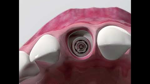 Fill The Gap Ridge Preservation with Geistlich Bio Oss® Collagen