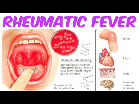 Video: Jak diagnostikovat revmatickou horečku: 13 kroků (s obrázky)