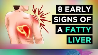 8 Signs You Have A FATTY LIVER