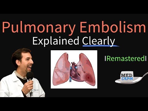 Video: Pulmonary Embolism - Symptoms, Treatment Of Pulmonary Embolism