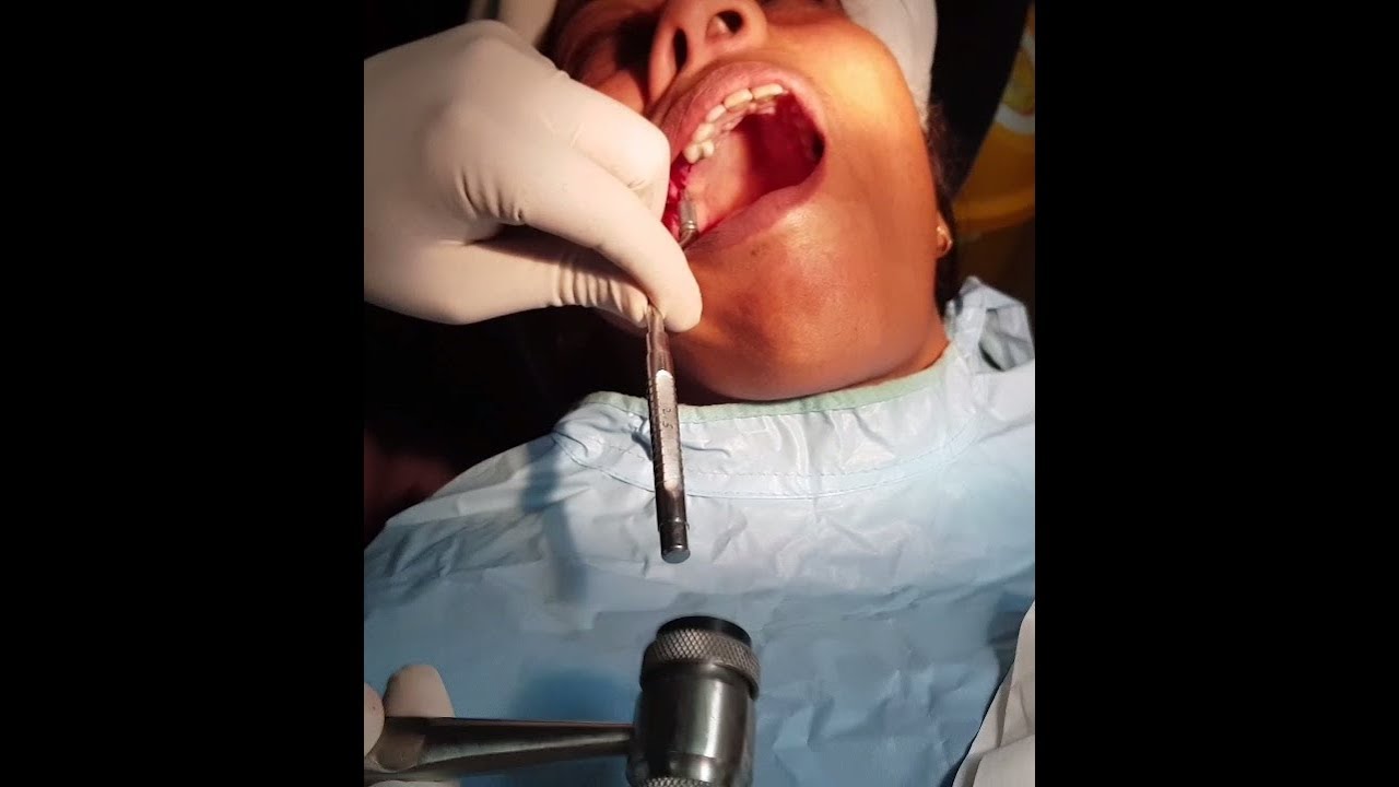 MEDSPO Knochenhammer – Mallet Für Implantat Chirurgie & Sinuslift (Knochen Mead Stil) Knochenimplantat Hammer MEDSPO Knochenhammer – Mallet Für Implantat Chirurgie & Sinuslift (Knochen Mead Stil) Knochenimplantat Hammer