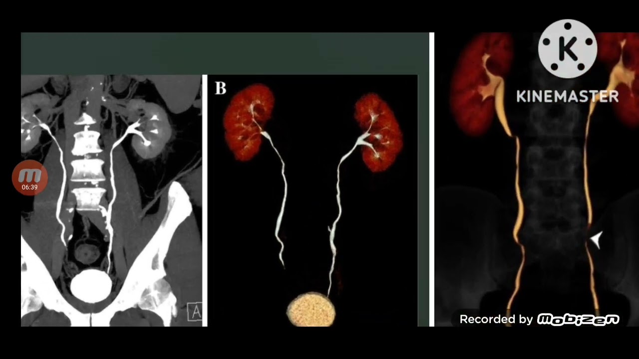 CT URINARY كيف تقوم بعمل فحص مقطعية علي المسالك البولية والتحضيرات اللازمة