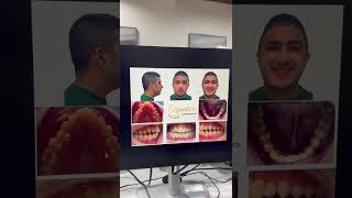 MSE Expander Orthodontic Case in Woodbridge VA | Smile Transformation by Dr. Ehab BenNasir