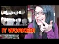 HOW I AVOIDED 3 ROOT CANALS NATURALLY - DENTISTS HATE THIS VIDEO! pt 2