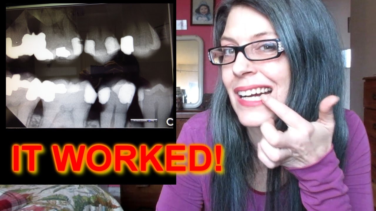 How I Avoided 3 Root Canals Naturally - Dentists Hate This Video! Pt 2