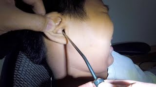 Removing Boy&#39;s HARD Earwax