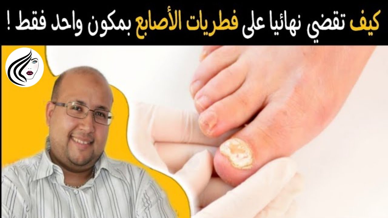 هذا المكون هو الوحيد القادر على القضاء على فطريات الأظافر مع الدكتور عماد ميزاب || dr imad mizab