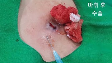 재발한  표피낭 (epidermal cyst, recurred)