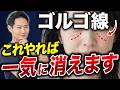 ゴルゴ線ができる原因と消すための正しい治療法を解説【美容医療】