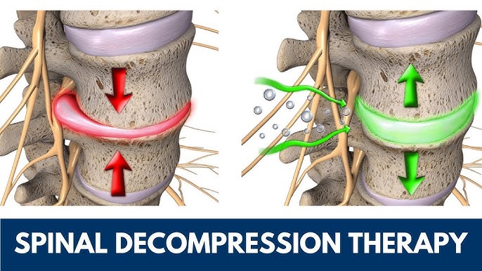 Neck, Back, and Sciatica Pain Relief with Spinal Decompression Therapy |  St. Joseph, MI - YouTube
