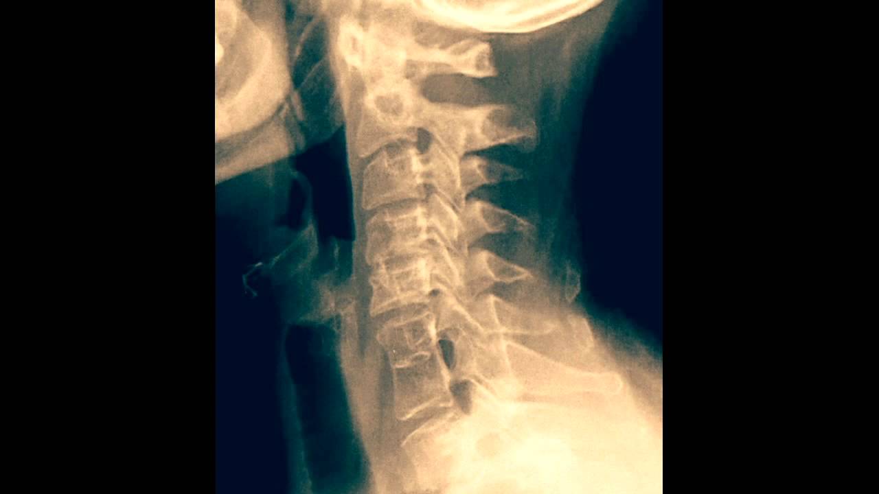 Bloque cervical C6 - C7 - Fusión vertebral cervical - YouTube