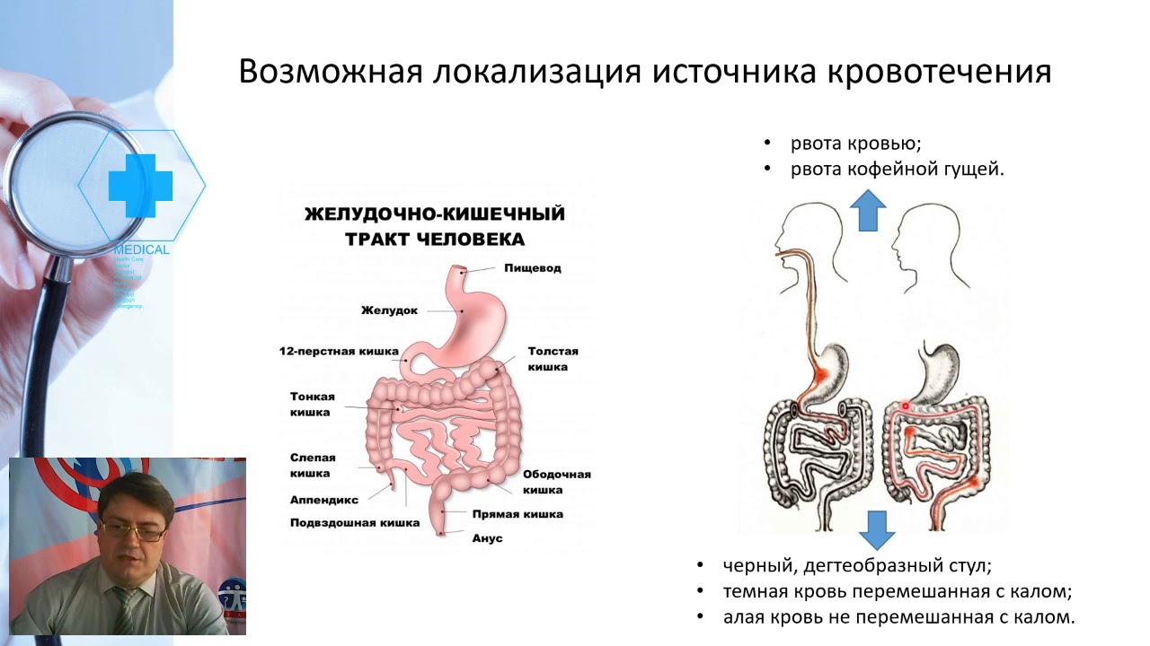 Желудочно кишечные кровотечения у детей. Кровотечение из верхних отделов ЖКТ. Желудочно кишечное кровотечение локализация. Кровотечение в пищеварительном тракте. Язвенные желудочно-кишечные кровотечения.