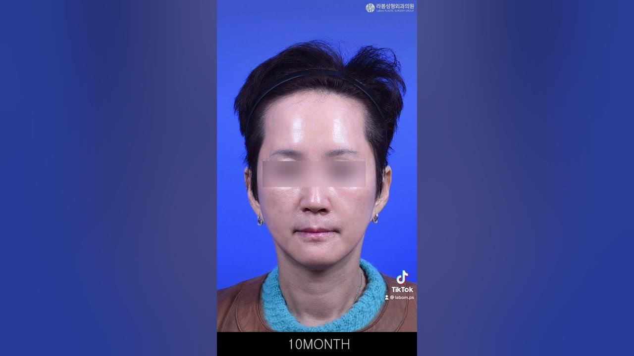 세월의 흔적이 가득한 얼굴라인 개선에 주목! 👀💕 10달차 사진 추가✨ - Youtube