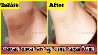 সপ্তাহে ১ দিন এই উপায়টি করলে বগলের কালো দাগ ছোপ দূর করে ত্বক ফর্সা উজ্জ্বল করে তুলবে।