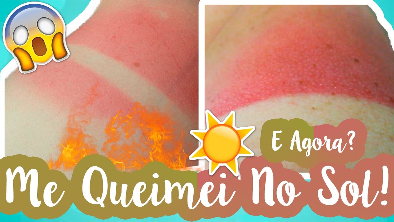 7 Dicas Para Prevenir e Tratar Queimaduras de Sol E Insolação! #VEDA8 ...