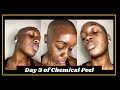 Skincare vlog day 3 am of my chemical peel for hyperpigmentation  texture  mikara reid