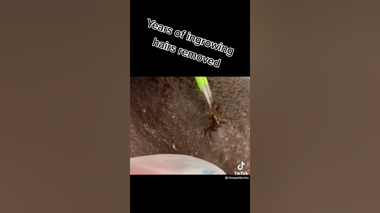 Ingrown hairs removal YouTube