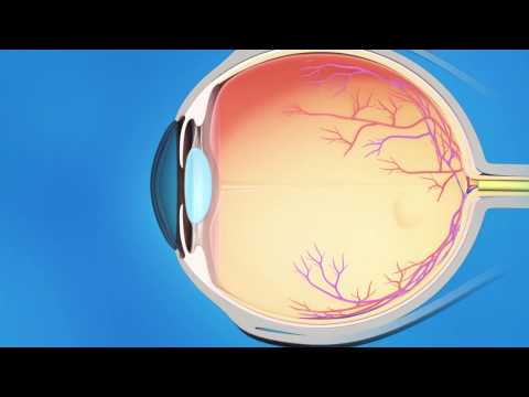 Laser Iridotomy for Glaucoma