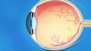 Laser Iridotomy for Glaucoma