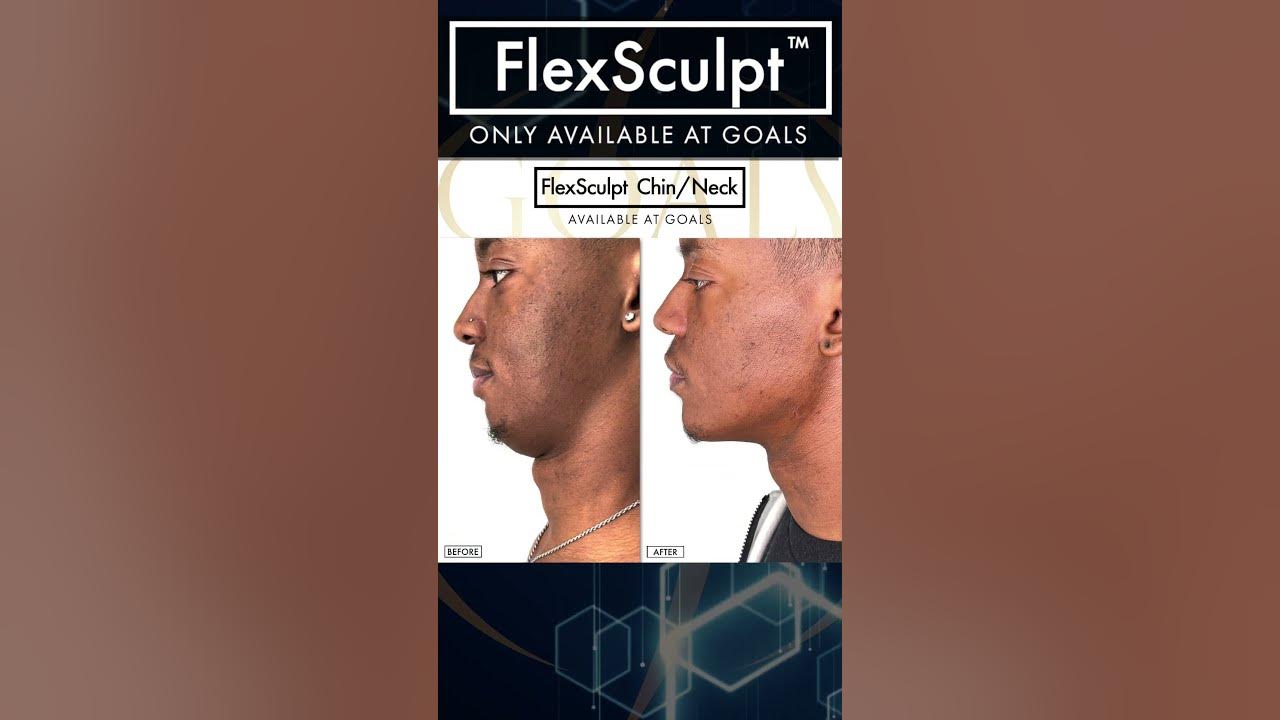 What Is Flexsculpt ? Check it out Only at Goals Plastic Surgery 