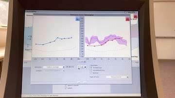 Understanding a hearing loss: normal hearing sloping to moderate hearing loss