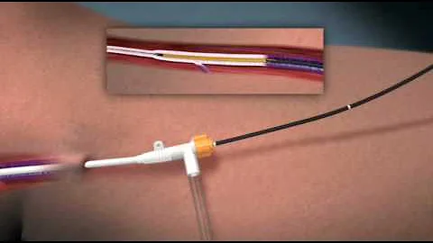 VNUS ClosureFAST Procedure