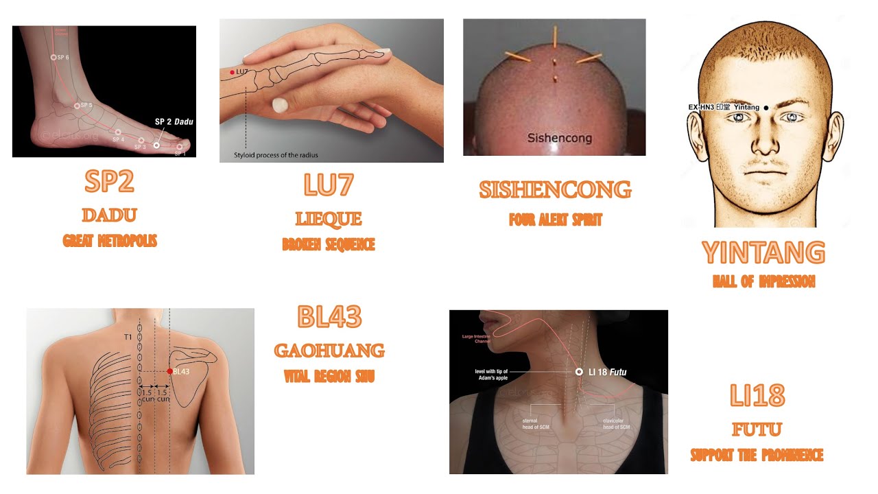 LAMP ACUPUNCTURE 23: SP2, LU7, SISHENCONG, YINTANG, BL43, LI18