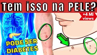 10 PRINCIPAIS SINAIS de DIABETES na PELE! (aparecem se você tem MUITO AÇÚCAR no sangue)