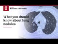 What you should know about lung nodules | Ohio State Medical Center