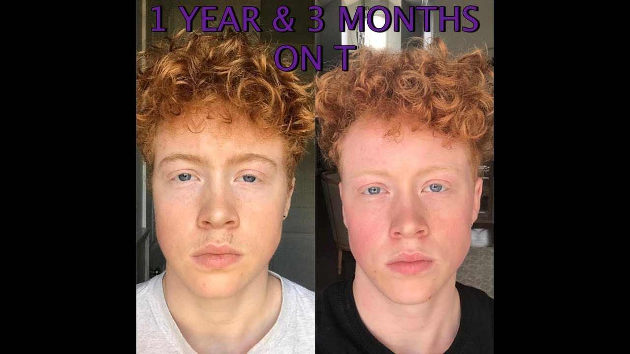 1 yr & 3 months on testosterone! FTM