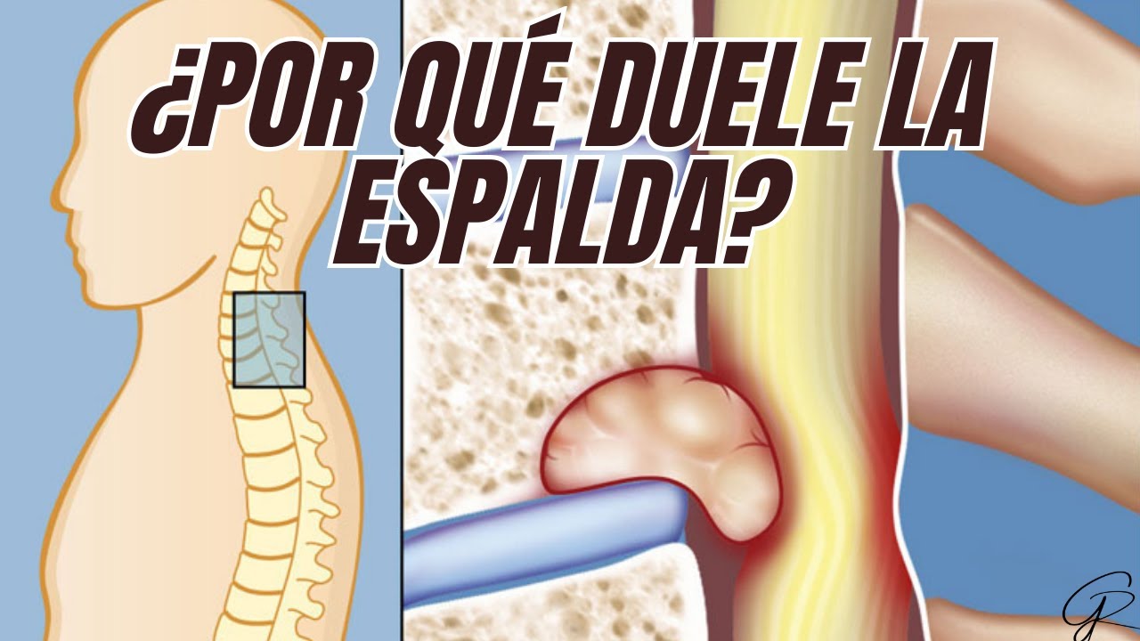Dolor Lumbar inéspecifico |  NO LO CONFUNDAS CON ESTO...
