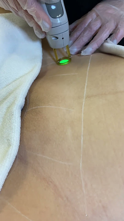 NUSHSKINCARE Brazilian Laser Hair Removal