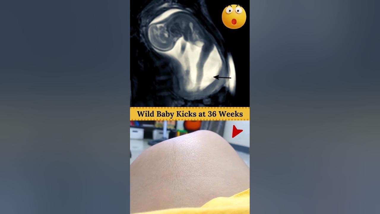 Fetal Movement in Mom's Belly π₯° #shortvideo #foryou Fetal Movement in Mom's Belly π₯° #shortvideo #foryou