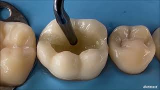 Ribbond Composite Restorations