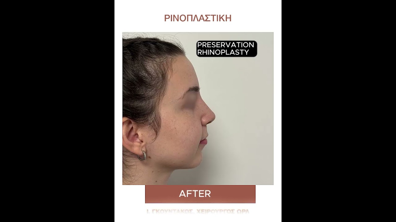 Ρινοπλαστική Πριν και Μετά (case 102)