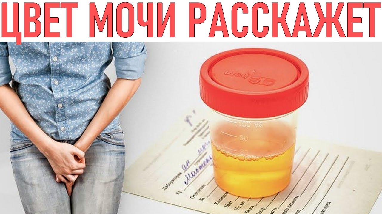 Цистит можно греть бутылкой. Моча при цистите у женщин. Цвет мочи при цистите. Цистит мутная моча. Моча при цистите у женщин цвет.