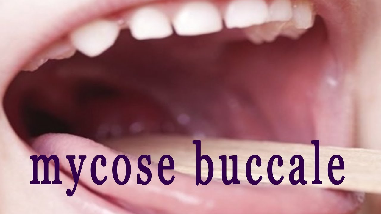 mycose buccal photo mycose buccal photo