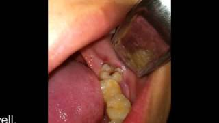 Dental Surgery  Partially Impacted Wisdom Teeth Removal