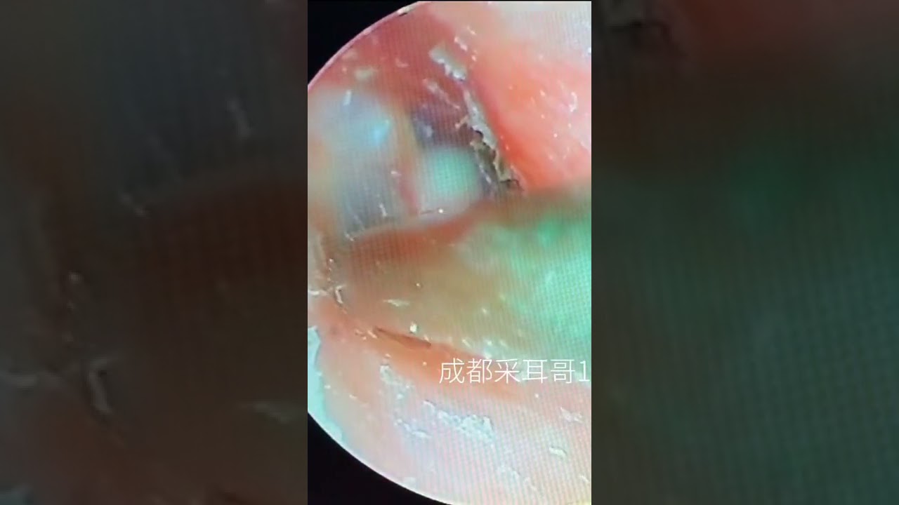 Satisfying Video Ear Wax Removal how to remove ear wax by endoscopic