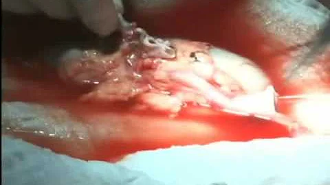 Como é feita a cirurgia de transplante de rins?