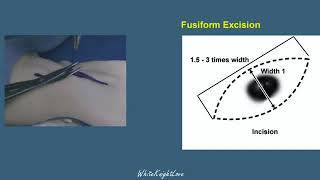 8 1 Fusiform Excision   Skin Flaps   Essential Surgical Skills WhiteKnightLove