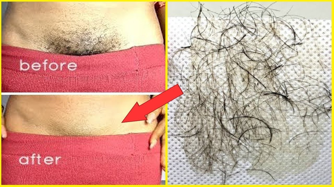 PUBIC HAIR REMOVAL HOME REMEDIES: How To Remove Pubic Hair Naturally With No Pain (Works 100%)