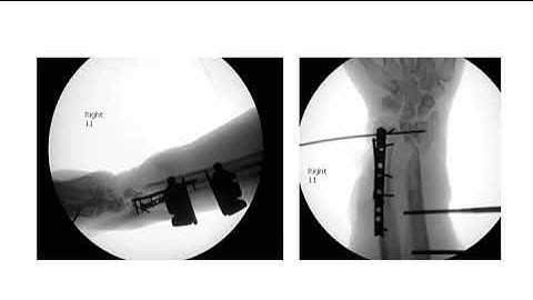 Fractures of Both Bones of the Forearm and the Distal Radius - OTA Online Trauma Access