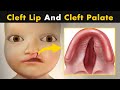 What Causes Cleft Lip And Cleft Palate? | symptoms, Causes And Treatment  (Urdu/Hindi)