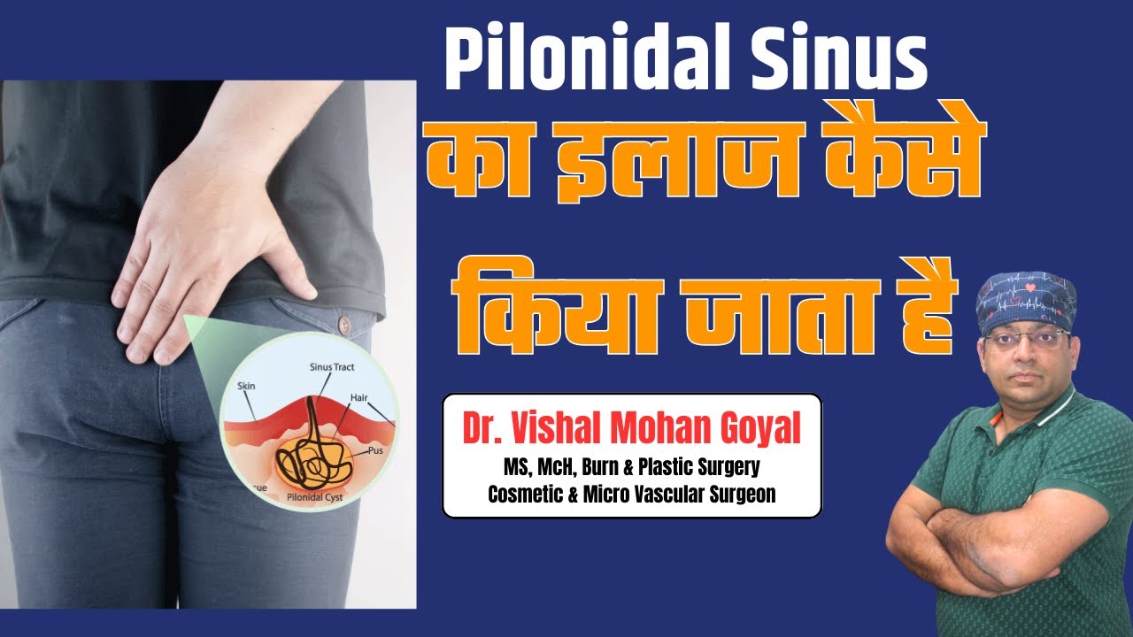 Pilonidal Sinus  का इलाज कैसे किया जाता है  || Dr. Vishal Mohan Goyal || 